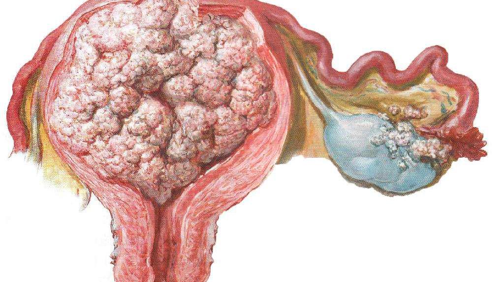 早期子宫内膜癌保留卵巢适应证快速指南（2021年版）