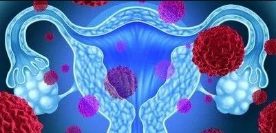 普通女性要筛查卵巢癌吗？《柳叶刀》发表20年随机试验结果