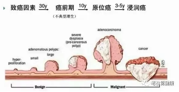  肠息肉切除后不复查，3年后变成晚期肠癌……