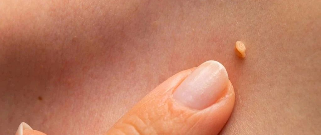  皮肤上长这种「小疙瘩」，可能和HPV感染有关……