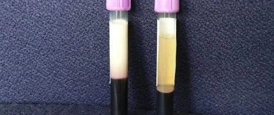  2岁孩子的血甘油三酯竟高达24.85mmol/L