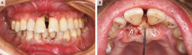  牙龈溃疡一个月，竟是因为肿瘤！