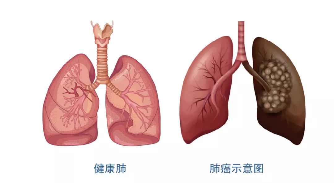 和您说说关于肺癌防治的肺腑之言