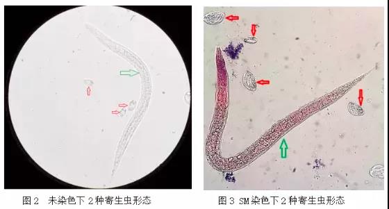 患者尿检中发现2种寄生虫，竟是因为干了这件事