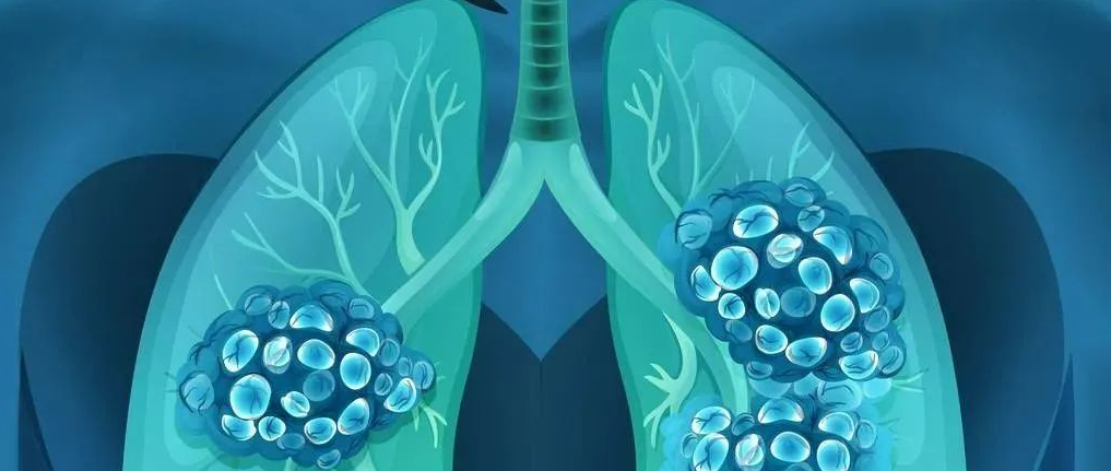 ADC联合疗法有望成为肺癌患者治疗的新选择
