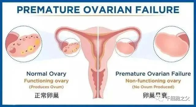 干细胞治疗早发性卵巢功能不全