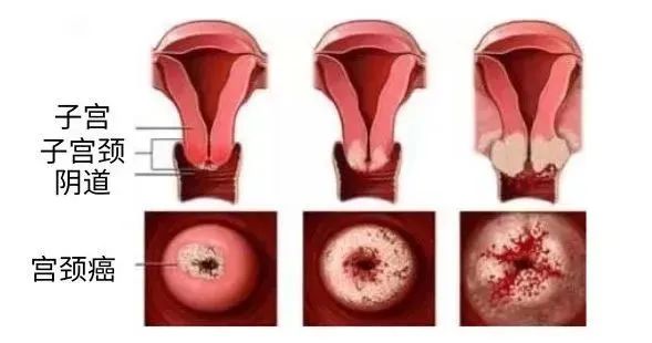 80%女性都会感染HPV？