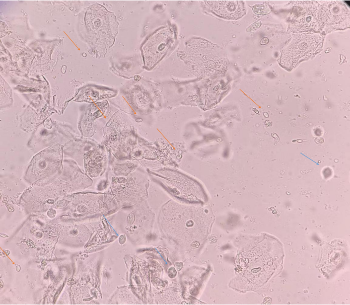 阴道分泌物中既生真菌，何生滴虫？