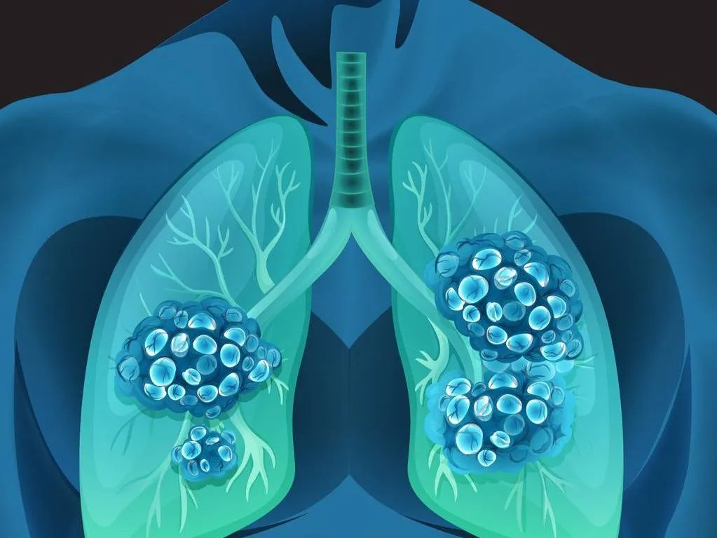 非小细胞肺癌联合治疗新策略