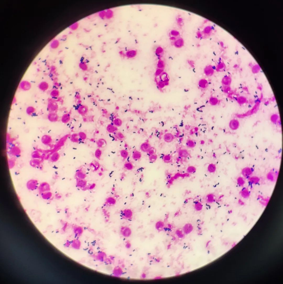 戈登链球菌——引起感染性心内膜炎的隐型杀手